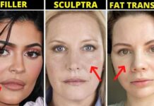 Lost Volume in your face Use one of these Filler, Sculptra or