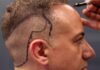 AI Breakthrough: Hair Transplants Without Scalpels Natural Hairline Design Explained: A Surgeon's Step-by-Step