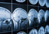 Popular Anti-Aging Drug Linked To Brain Damage Close-up of MRI brain scans displayed on a screen
