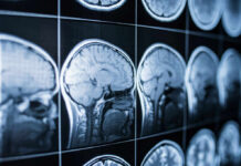 Popular Anti-Aging Drug Linked To Brain Damage Close-up of MRI brain scans displayed on a screen