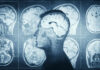 Migraine Mystery: Why Women Suffer More MRI scans of the brain displayed alongside a silhouette of a human head