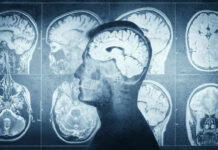 Migraine Mystery: Why Women Suffer More MRI scans of the brain displayed alongside a silhouette of a human head