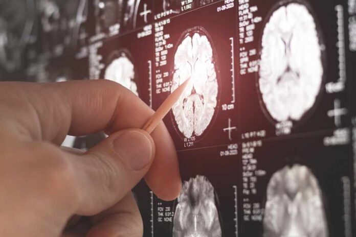 A hand pointing at a brain MRI scan on a screen