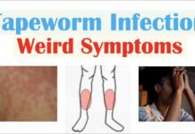 The Deadly Tapeworm Spreading Across America Weird Symptoms of Tapeworm Infection (Skin, Psychological, Neurological)
