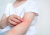 Blackcurrant seed oil for Eczema Treatment? Child's arm showing skin irritation and redness