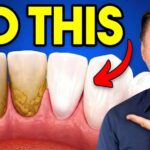The #1 BEST Remedy for Dental Plaque (TARTAR)