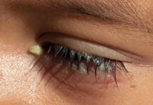 Closed human eye with discharge on eyelashes
